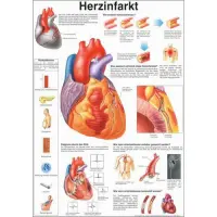 "Das menschliche Herz" u. "Herzinfarkt" Herzinfarkt | Poster 50 x 70 cm | unlaminiert