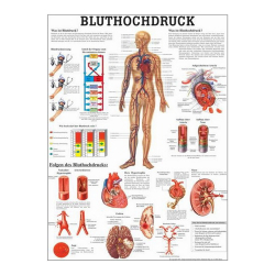 Bluthochdruck Bluthochdruck des Menschen | Poster 50 x 70 cm | unlaminiert