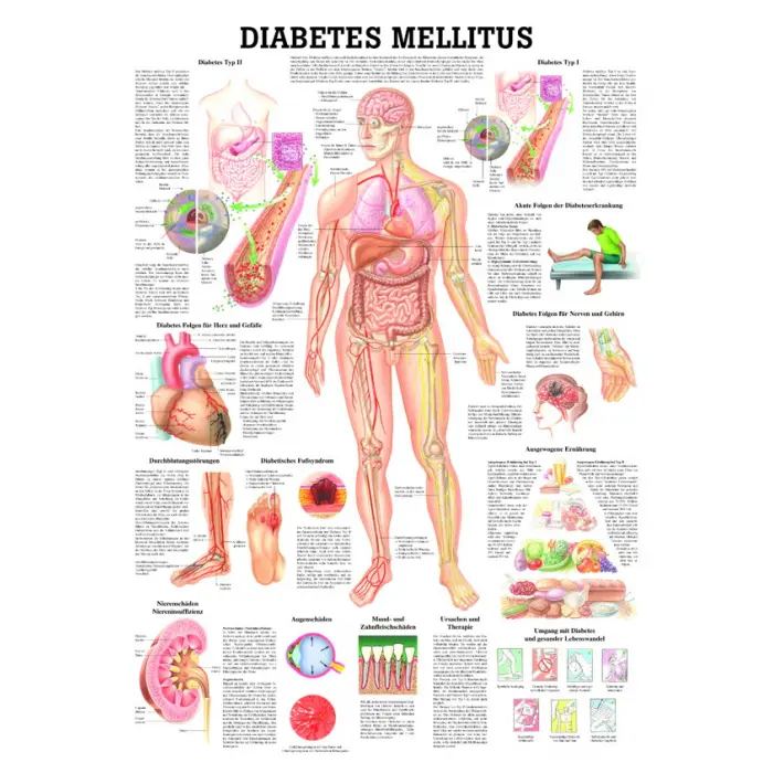 Diabetes Mellitus unlaminiert